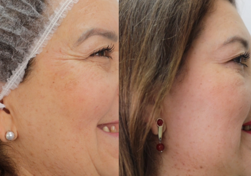 antes-botox