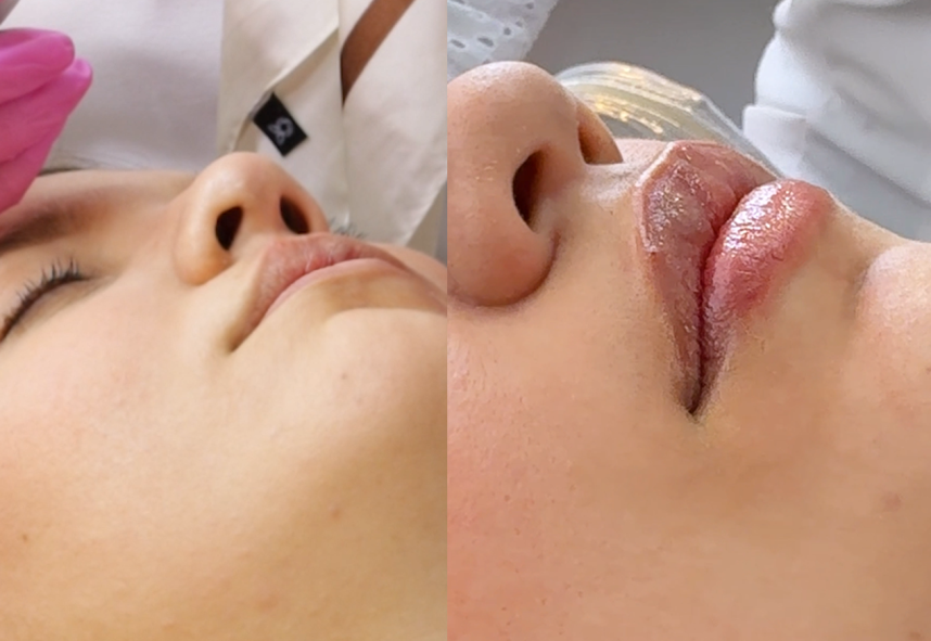 antes-labios